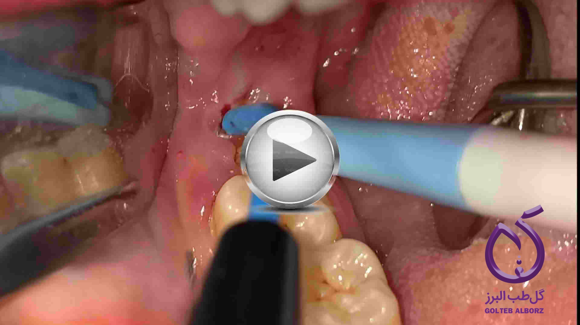 ویدئو جراحی دندان عقل فک پائین و بالا