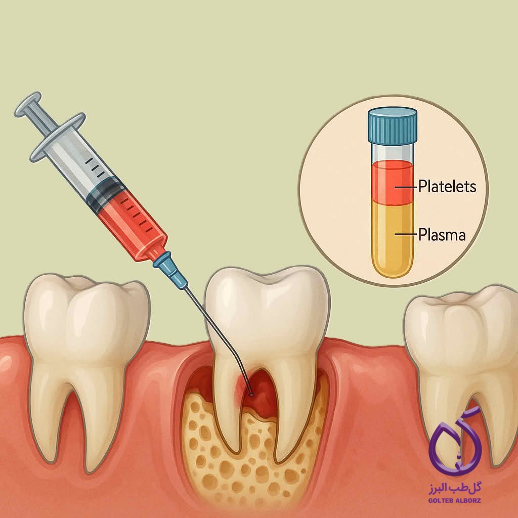 Illustration of PRP (Platelet-Rich Plasma) application in dental surgery showing injection near a tooth root and a labeled test tube of plasma and platelets, highlighting its role in bone and tissue regeneration