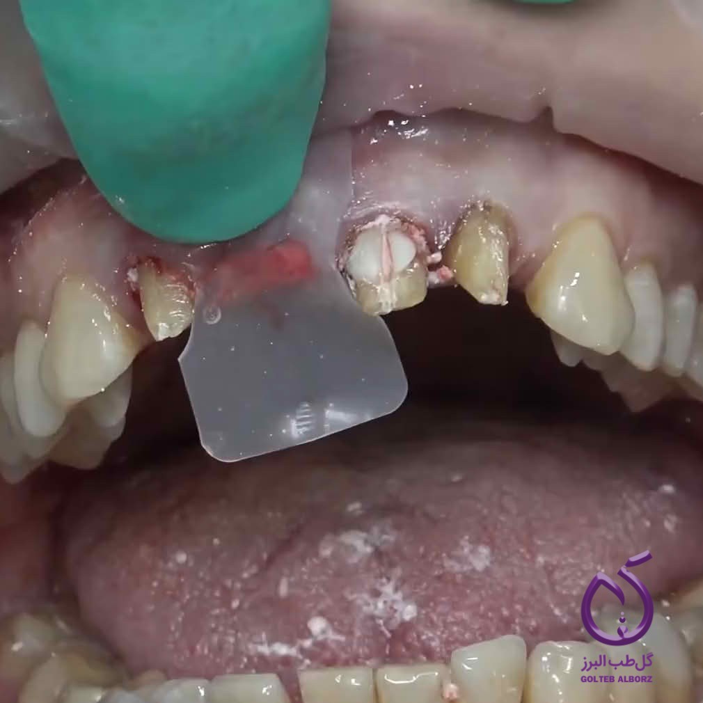 Speed Up Tooth Socket Healing with Ora-Aid Oral Dressings